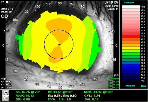 露晰得角膜塑形镜的技术创新亮点